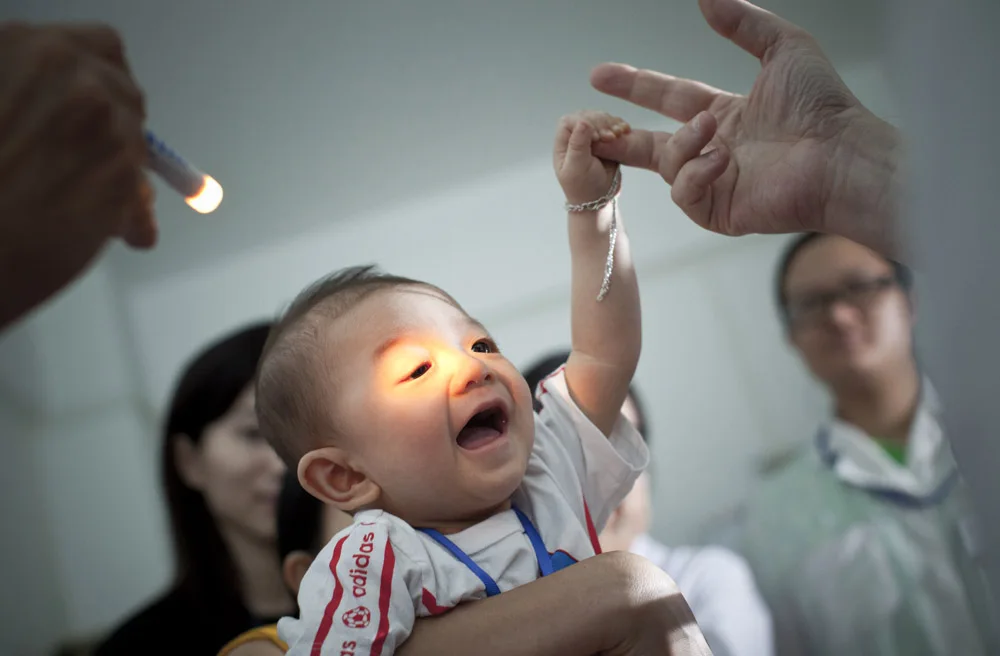 Orbis Flying Eye Hospital Program - Hanoi, Vietnam - May-June 2015 - Do Anh Bao, 8 months, clung with enthusiasm to Dr. James Brandt's finger while being examined in the pediatric glaucoma clinic during Week 2 of the Orbis Hanoi program.